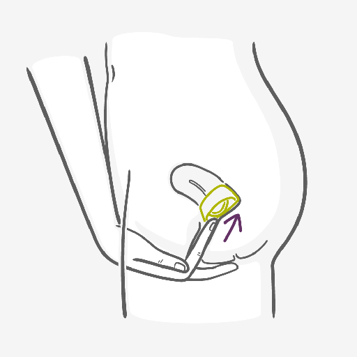 Cervical Cap How to use