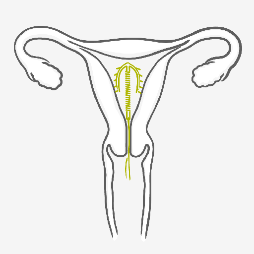 Intrauterine Device - IUD - How to use