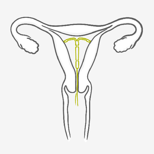 How to use Intrauterine System - IUS